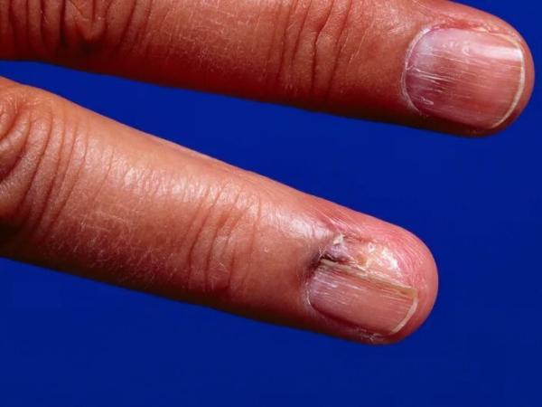 خطی روی ناخن که نشانه یک سرطان تهاجمی پوست بود