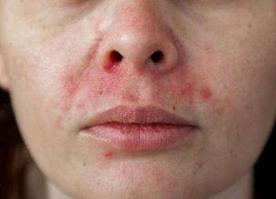 توصیه های متخصصان پوست در خصوص اگزمای صورت